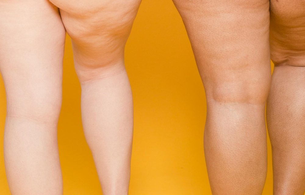 Get Rid Of Cellulite Before Summer